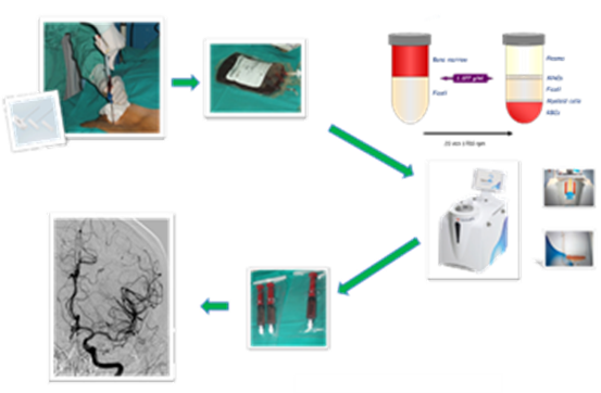 Overview of the cell extraction and transplantation process for techtransfer