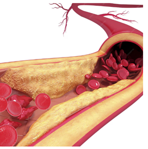Biomarkers for the prediction and diagnosis of severe atherosclerosis for techtransfer